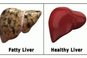 214622_bangladesh_pratidin_fatty-liver-disease-information-on-symptoms-causes-and-treatment-1-638